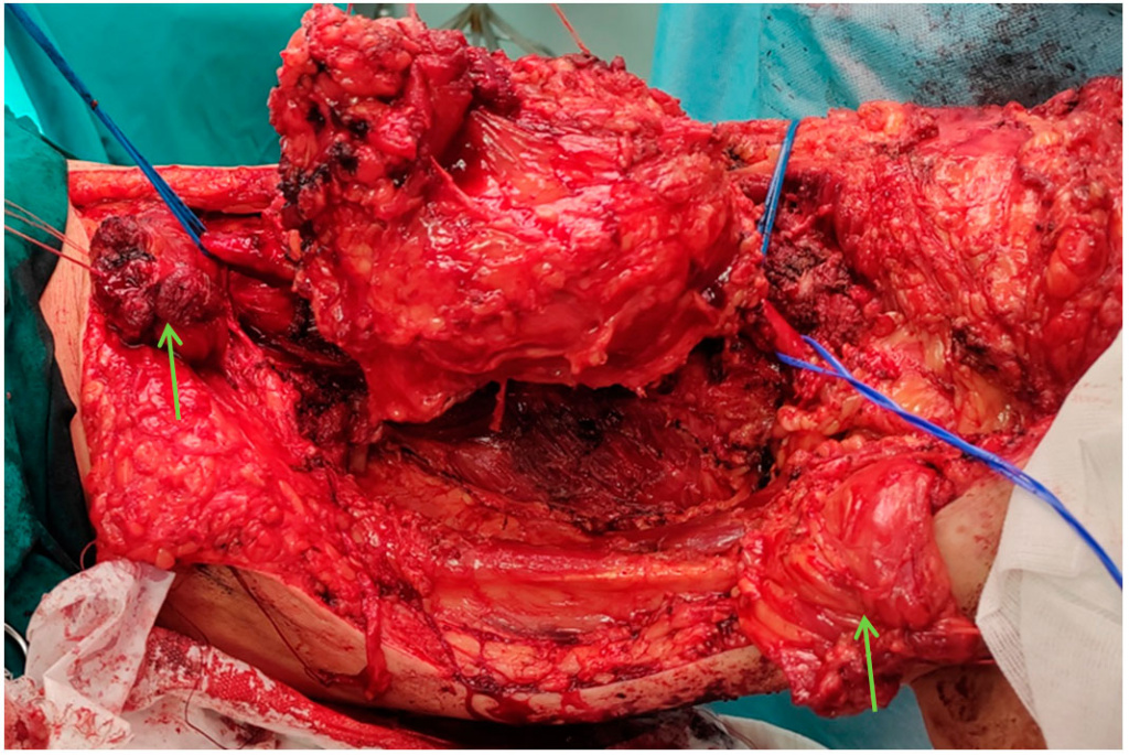 Хирургическое лечение рецидива солитарной фиброзной опухоли мягких тканей